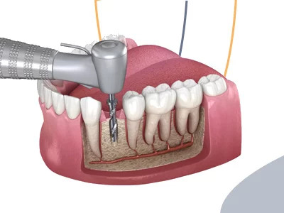 animation showing root canal treatment procedure