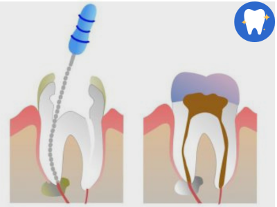 benefits of root canal treatment