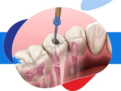 Root Canal Treatment at smile signature dental clinic