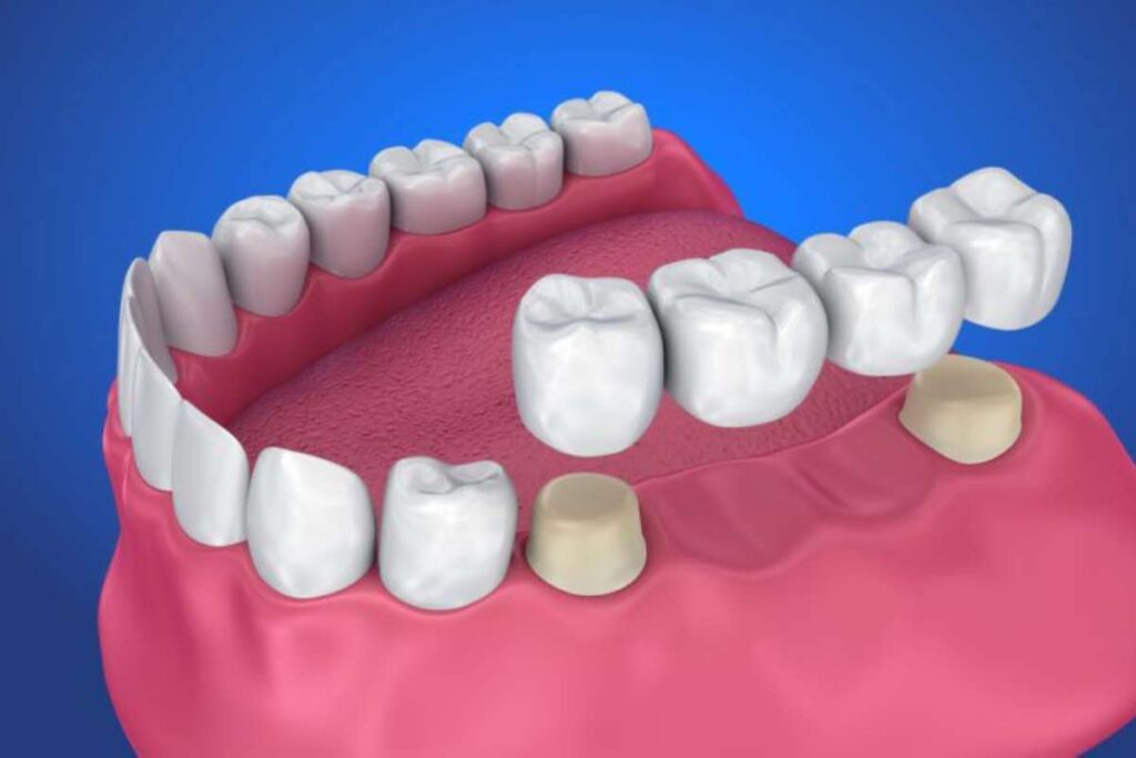 How Long Do Crowns and Bridges Last? Here’s What You Need to Know